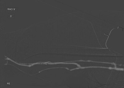 01 CO2 Angiography with contrast agent injector Inspect 3005R